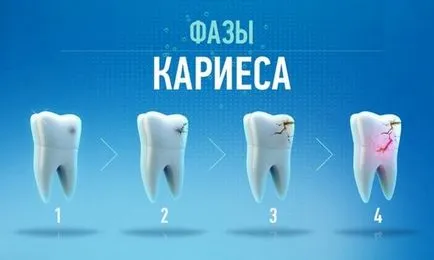 Megelőzés fogszuvasodás gyermekeknél és felnőtteknél, megfelelő szájhigiénia (ek) Megelőzés fogszuvasodás gyermekeknél és felnőtteknél, megfelelő szájhigiénia