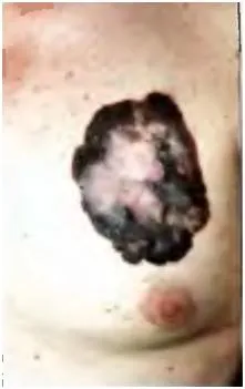 Bőrrák, melanoma - okai, tünetei és kezelése