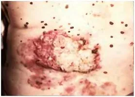 Bőrrák, melanoma - okai, tünetei és kezelése