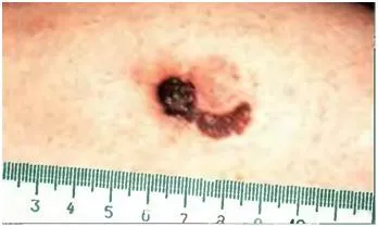 Bőrrák, melanoma - okai, tünetei és kezelése