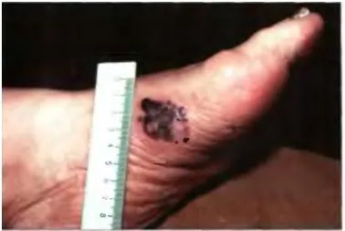 Bőrrák, melanoma - okai, tünetei és kezelése