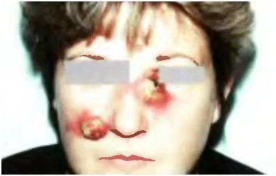 Bőrrák, melanoma - okai, tünetei és kezelése