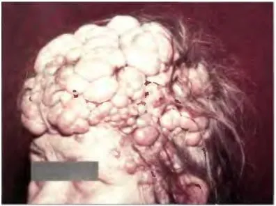 Bőrrák, melanoma - okai, tünetei és kezelése