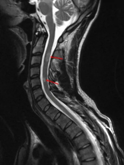 A szklerózis multiplex az MRI jellemzők és diagnosztika sclerosis multiplex