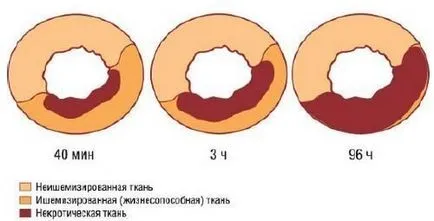 Szívinfarktus