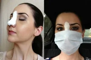 Helyezze orr törés sérülés után videók, fotók, hatásai