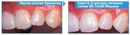 Ásványi anyagokat pótló gél gc fog mousse fogak (myc mousse) utasítás vélemény