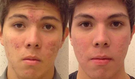 Roaccutane véleménye, használati utasítások, ár, analógok, a mellékhatások (Roaccutane analógok) Roaccutane véleménye, használati utasítások, ár, analógok, mellékhatások