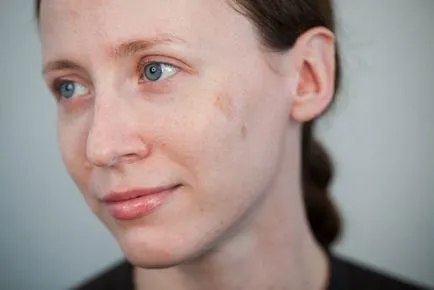 Rosacea Arckezelés, tünetek, okok, hogyan kell gyógyítani