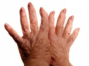 Szanatórium rheumatoid arthritis és kezelési módszerek (kezelés) Szanatórium rheumatoid arthritis és kezelési módszerek