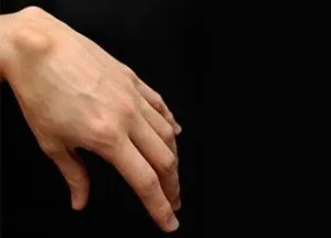 Dudorok a kezét a bőr alatt a tenyerével és az alkar - az okok (fotó) (pálma) Dudorok a kezét a bőr alatt a tenyerével és az alkar - az okok (Fotók)