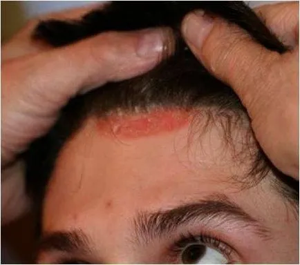 Peeling fejbőr miért erősen Hámozott a gyerek, mit kell tenni (a bőrön) Peeling fejbőr miért erősen kifejtve a gyerek, mit kell tenni