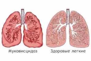 Tünetei cisztikus fibrózisban szenvedő gyermekek és felnőttek
