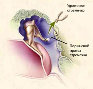 A tünetek és a kezelés az otosclerosis (kezelés) Tünetei és kezelése otosclerosis
