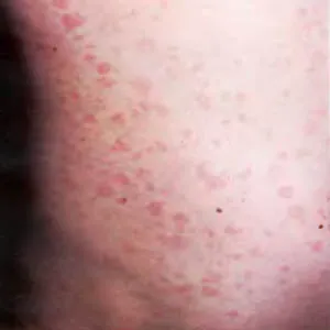 Szifilisz - Causes, tünetek és kezelés (STI) Szifilisz - okai, tünetei és kezelése