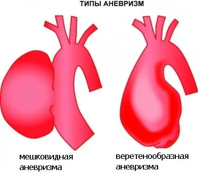 Tünetek, megelőzés és a kezelés a hasi aorta aneurizmák által (aneurizma) Tünetek, megelőzés és a kezelés a hasi aorta aneurizmák a