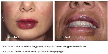 A törődés után ajakfeltöltés hialuronsav, hogyan kell kezelni a vérömlenyek (zúzódás után hialuronsav ajkak) Zúzódás után ajakfeltöltés hialuronsav, hogyan kell kezelni a zúzódások