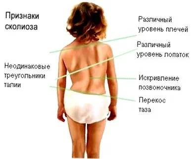 Scoliosis típusok okok, tünetek, tünetei és kezelése