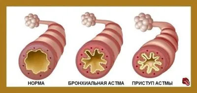 Hányan vannak a kórházban tüdőgyulladással (pneumonia) Hányan vannak a kórházban tüdőgyulladással