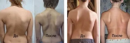 Scoliosis típusok okok, tünetek, tünetei és kezelése