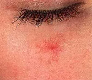 Spider erek az arcon, a lábak, eltávolítása, kezelésére, megelőzésére, az egészségügyi ábécé (vaszkuláris) Seprűvénák az arcon, a lábak, a gyűjtése, kezelése, megelőzése, egészségügyi ábécé