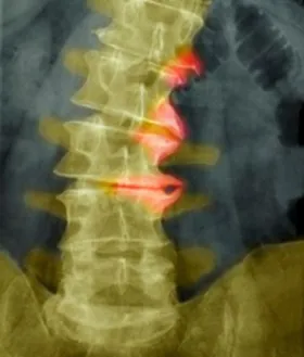 Spondylosis, mi ez
