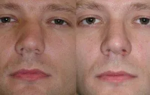 Módszerek, hogy összehangolják az orrsövény műtét nélkül - az életem (műveletek) Módszerek, hogy összehangolják az orrsövény műtét nélkül - az életem