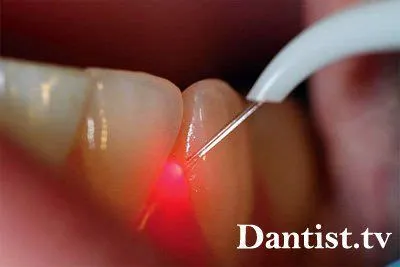 Laser Dentistry mi ez, az ár és a képek (az ár és fotók) Laser Dentistry mi ez, az ár és a képek