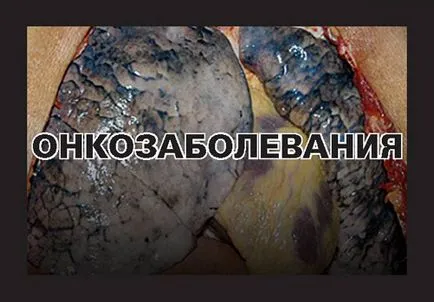 Szörnyű képek „a magyar dohányosok