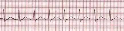 Tachyarrhythmia mi ez, tünetei és kezelése
