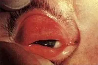 A trachoma - okai, tünetei, diagnózisa és kezelése