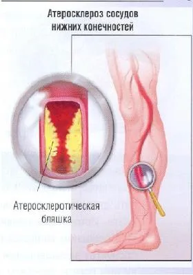 Transmuralis szívinfarktus mi előrejelzése, tünetei és kezelése