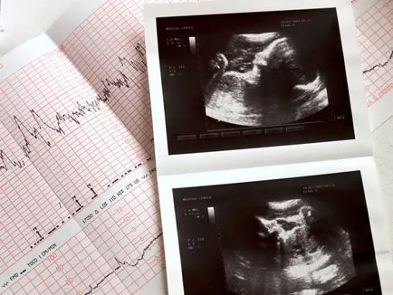 Hogyan megfejteni az eredménye CTG Hogyan megfejteni az eredménye CTG