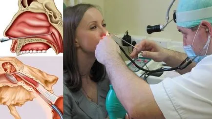 Tubo-otitis tünetek és a kezelés felnőtteknek, és hogyan kell kezelni a okait (kezelt) Petevezeték középfülgyulladás tünetek és a kezelés felnőtteknek, hogyan kell kezelni és okai