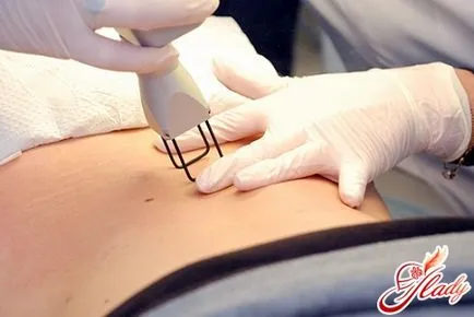 Távolítsuk el striák Laser - akár