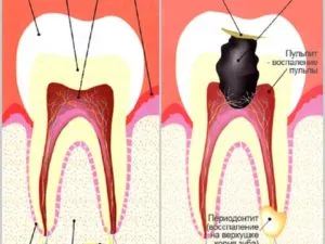 Tooth ideg a fogat, mint a kezelés, hogy miért és mennyi ideig hatásainak kiküszöbölése (fog) Tooth ideg a fogat, mint a kezelés, hogy miért és mennyi ideig hatásainak kiküszöbölése