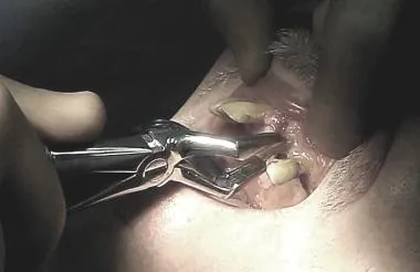 Extractions - ha törölni egy fogat (következik) Fogeltávolítás - el kell távolítani, ha a fogat