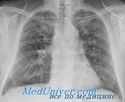 Amplification, csillapítás és a torzítás ábra pulmonális