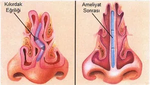 Vasotomy orrkagylócsontok mi ez okoz egy műveletet az alsó részén az orr és a típus (a) Vasotomy orrkagylócsontok mi ez okoz egy műveletet az alsó része az orr és típusok