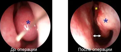Vasotomy orrkagylócsontok, nyálkahártya alatti reszekció orr (nazális) Vasotomy orrkagylócsontok, nazális szubmukozális reszekció