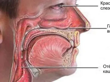 Vasotomy orrkagylócsontok mi ez okoz egy műveletet az alsó részén az orr és a típus (a) Vasotomy orrkagylócsontok mi ez okoz egy műveletet az alsó része az orr és típusok