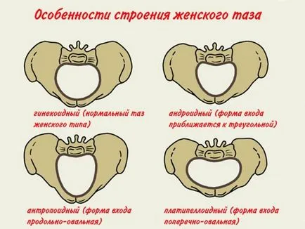 Keskeny medence a terhesség és a szülés okokból besorolás, jelek