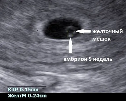 Uzi, hogy meghatározza a terhesség korai szakaszában