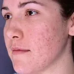 Típusú pattanások az arcon és a test, akne különböző fotó