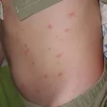 Típusú pattanások az arcon és a test, akne különböző fotó