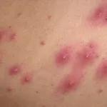 Típusú pattanások az arcon és a test, akne különböző fotó