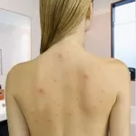 Típusú pattanások az arcon és a test, akne különböző fotó