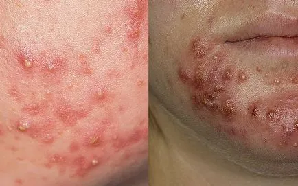 Típusú pattanások az arcon a bőr alá, a víz, a kék és mások (acne) Típusú akne az arc bőre alá pattanás, víz, kék és mások
