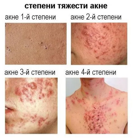 Típusú akne leírása és jellemzői a főbb típusú akne - mik a főbb különbségek