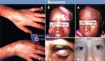 Vitiligo - impresszum aura vagy betegség, amelyből jelennek meg a bőrön fehér foltok